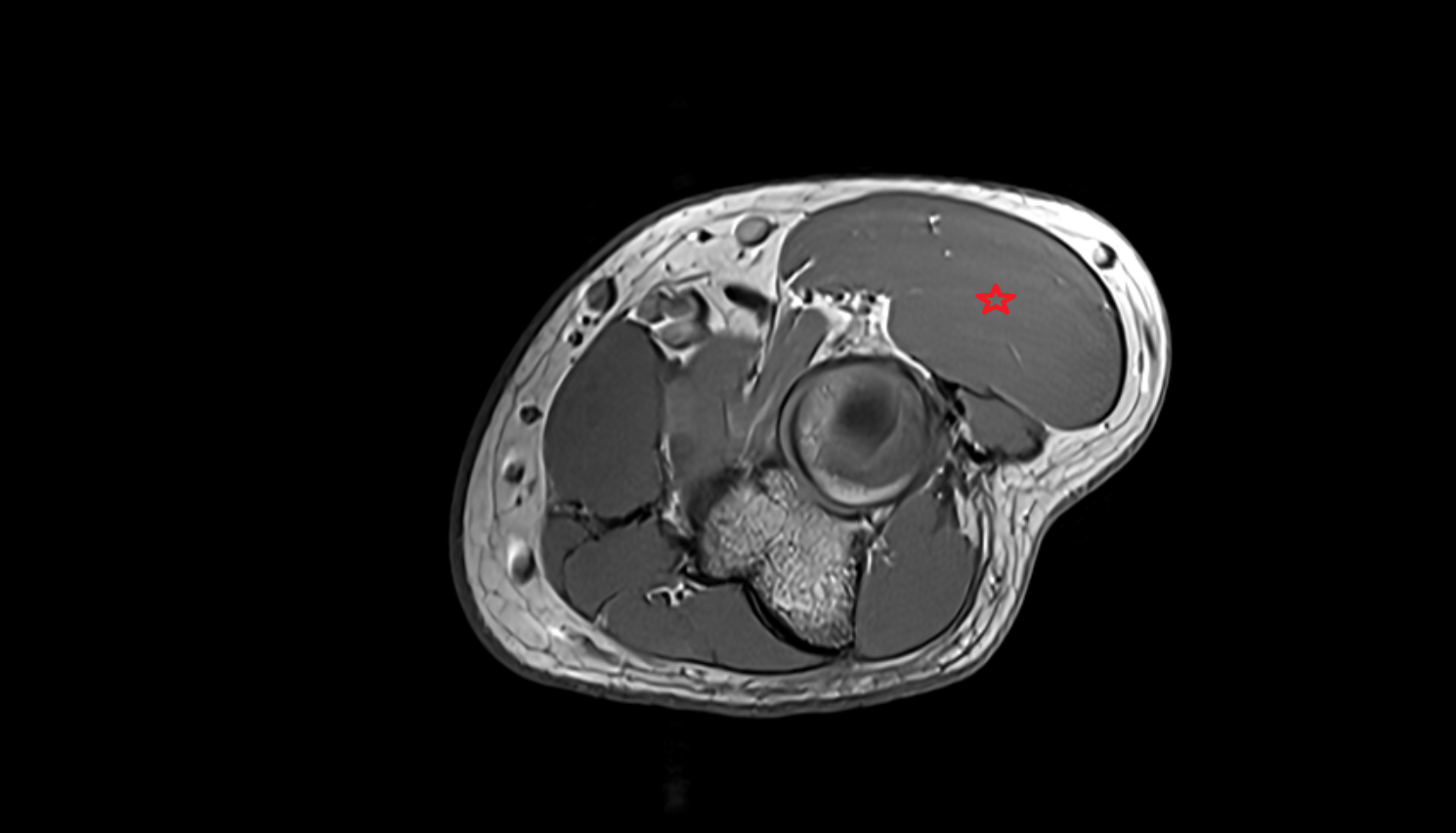 Extensor carpi radialis longus muscle  axial cross sectional anatomy 3T MRI AI enhanced radiology image -img-00000-00000_00003