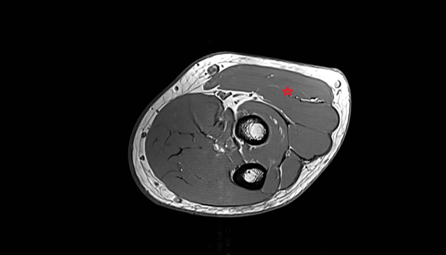 Extensor carpi radialis longus muscle  axial cross sectional anatomy 3T MRI AI enhanced radiology image -img-00000-00000_00004