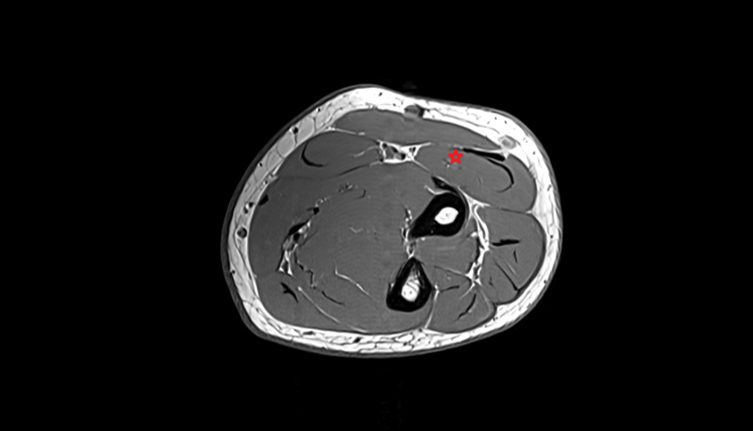 Extensor carpi radialis longus muscle  axial cross sectional anatomy 3T MRI AI enhanced radiology image -img-00000-00000_00005