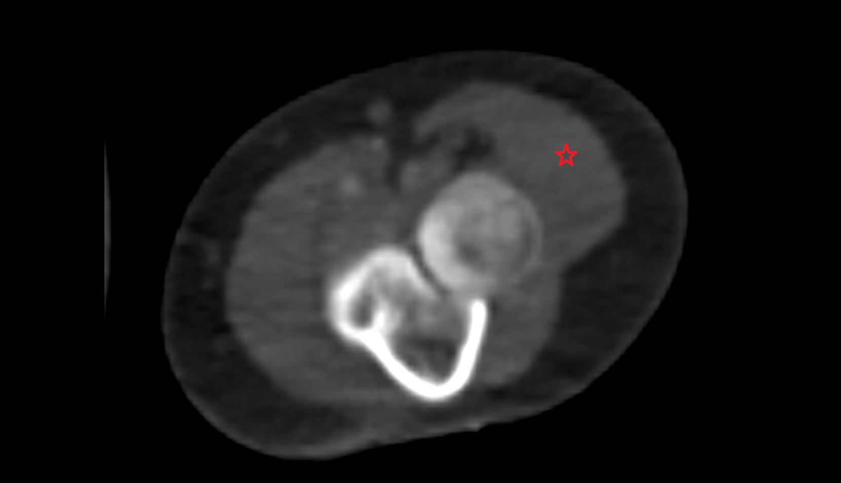 Extensor carpi radialis longus muscle ct axial