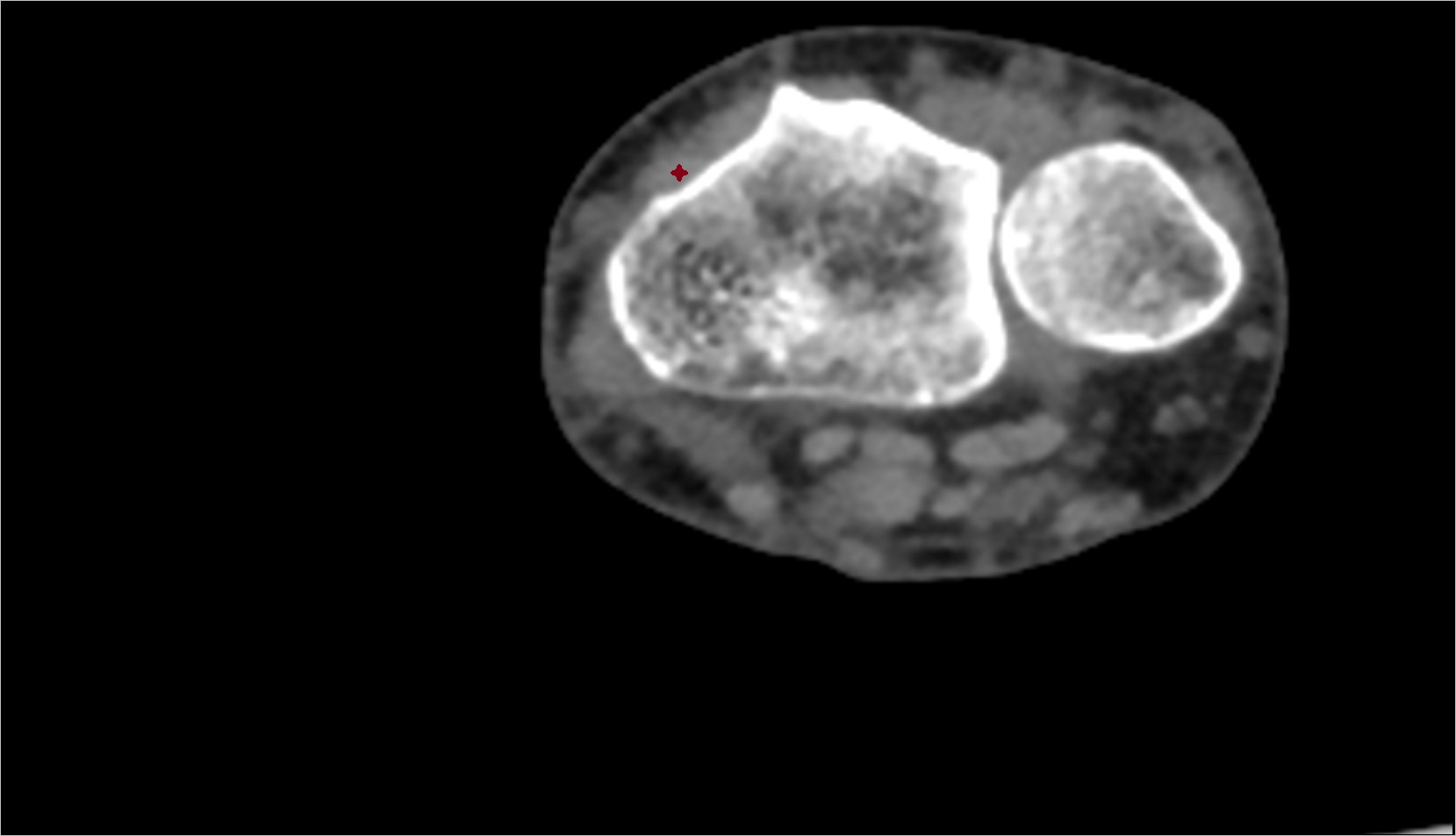 Extensor carpi radialis longus tendon CT