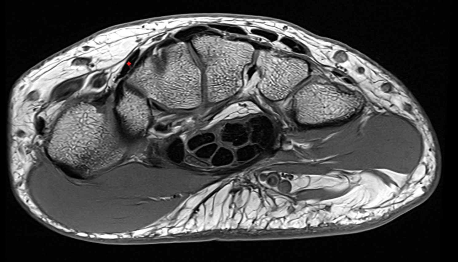 Extensor carpi radialis longus tendon  axial cross sectional anatomy 3T MRI AI enhanced radiology image-img-00000-00000