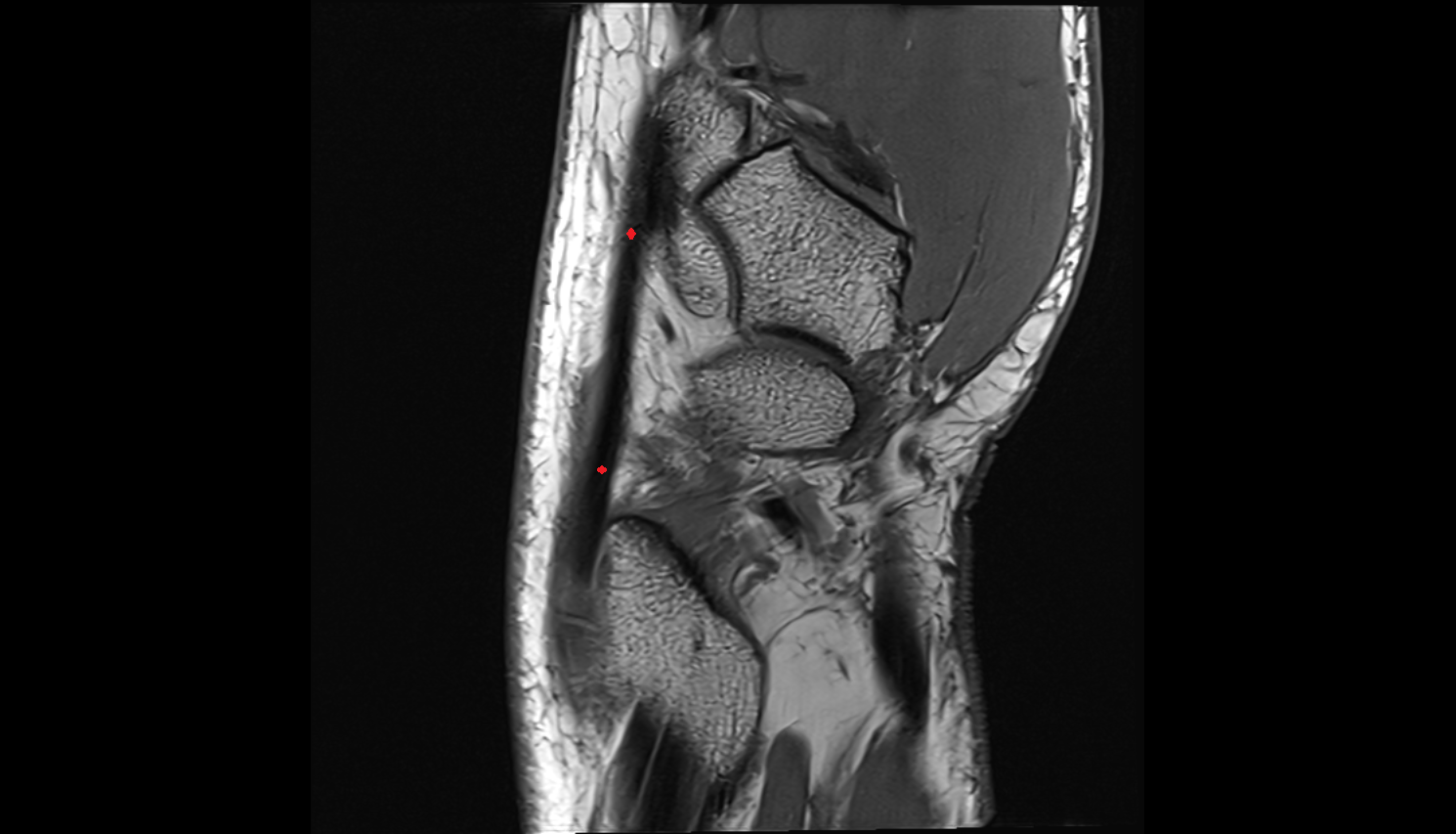 Extensor carpi radialis longus tendon  axial cross sectional anatomy 3T MRI AI enhanced radiology image-img-00000-00000_00002