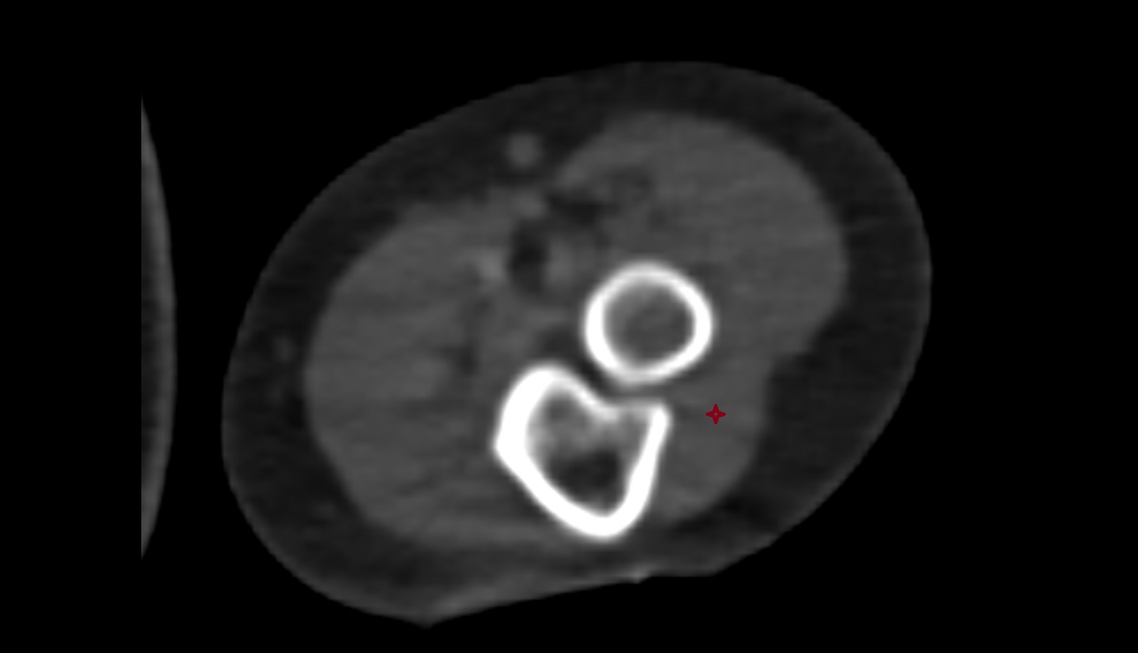 Extensor carpi ulnaris ct axial image