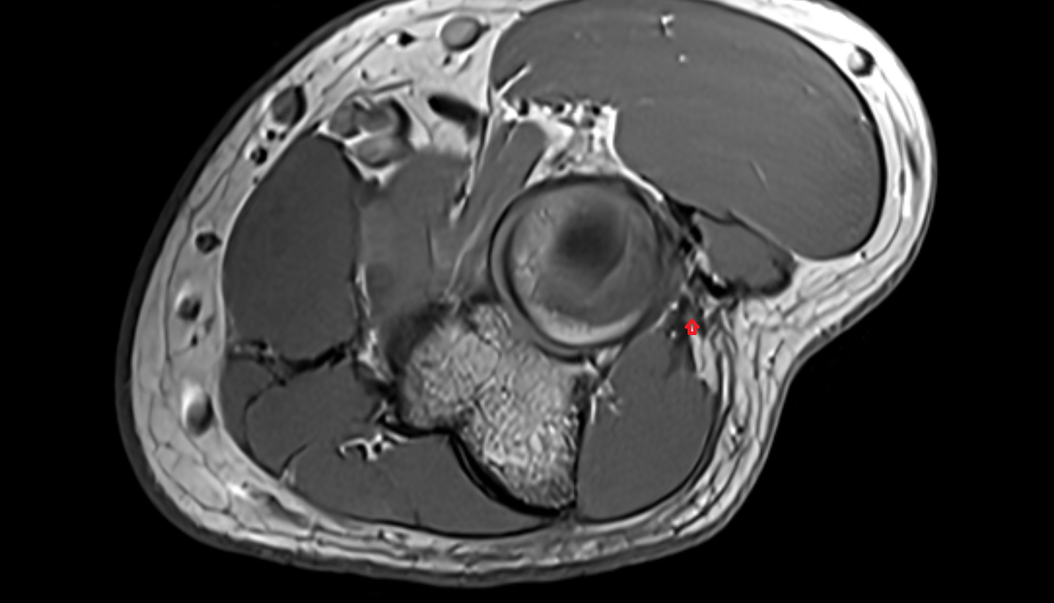 Extensor carpi ulnaris muscle (Humeral Head)  axial cross sectional anatomy 3T MRI AI enhanced radiology image -img-00000-00000