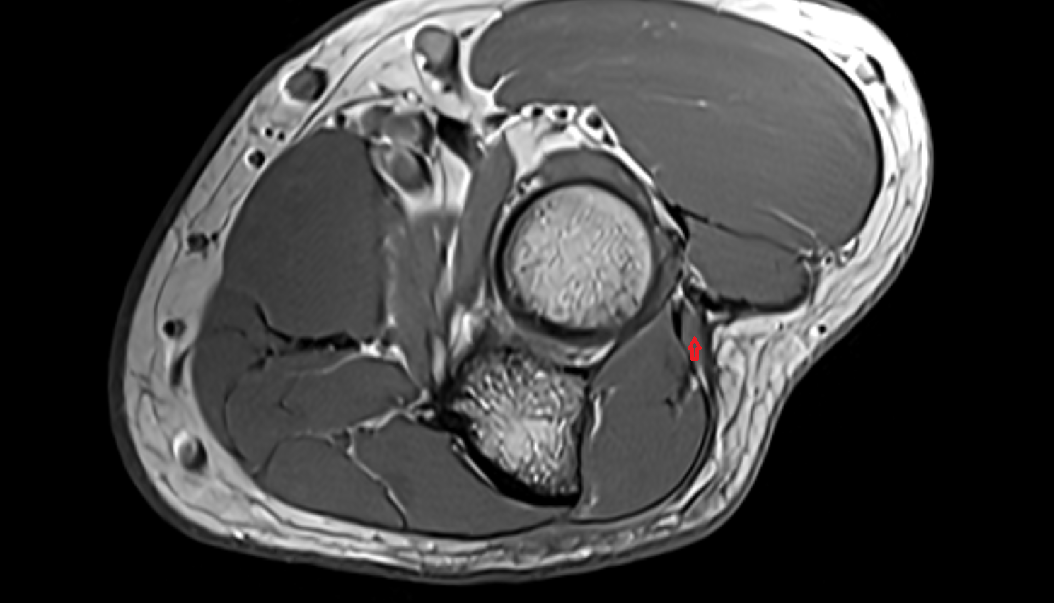 Extensor carpi ulnaris muscle (Humeral Head)  axial cross sectional anatomy 3T MRI AI enhanced radiology image -img-00000-00000_00001