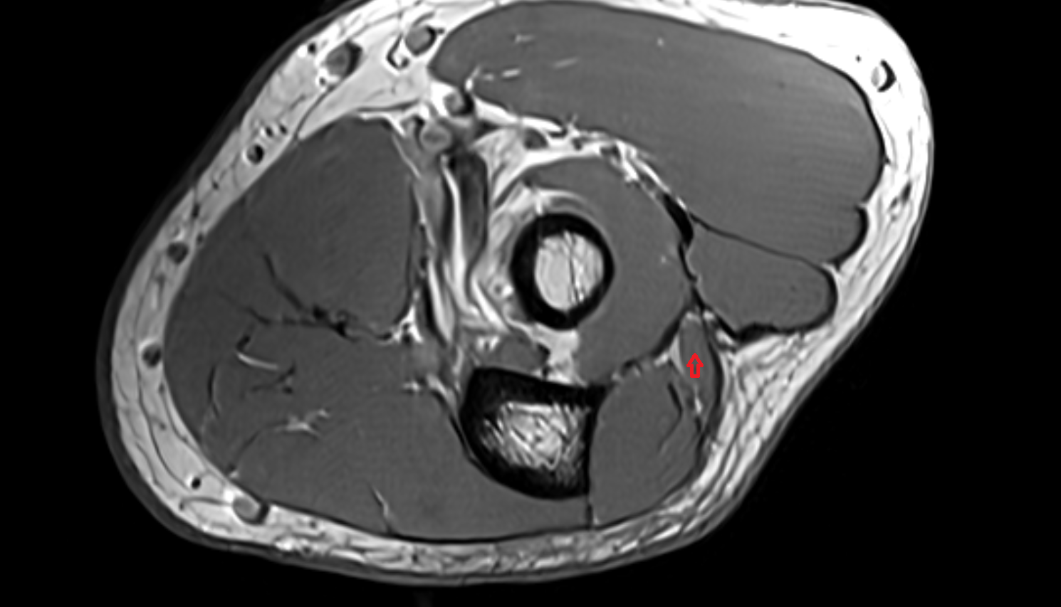 Extensor carpi ulnaris muscle (Humeral Head)  axial cross sectional anatomy 3T MRI AI enhanced radiology image -img-00000-00000_00002