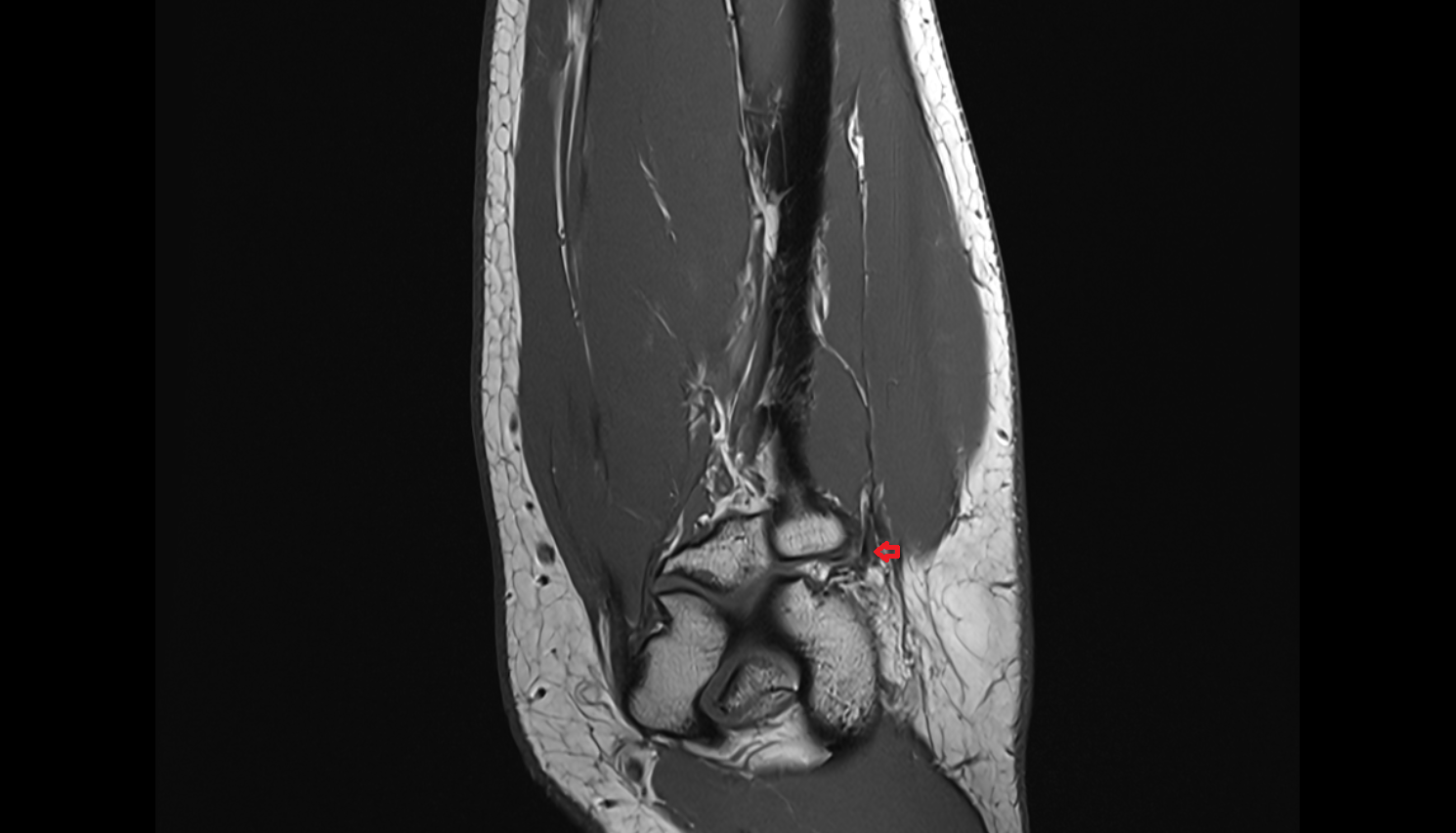 Extensor carpi ulnaris muscle (Humeral Head)  coronal cross sectional anatomy 3T MRI AI enhanced radiology image -img-00000-00000_00003