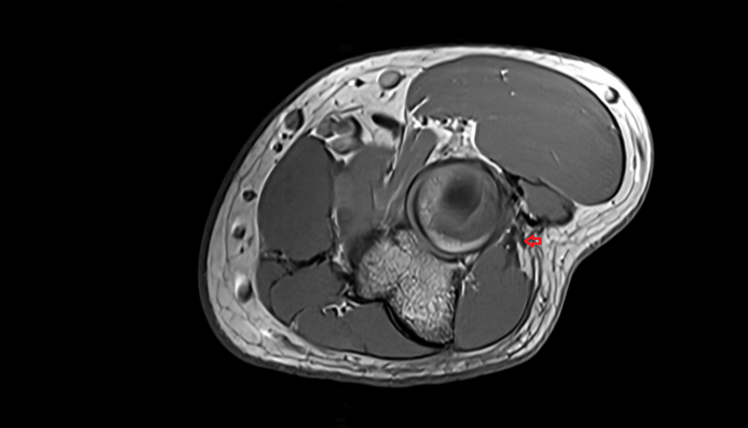 Extensor carpi ulnaris  muscle  axial cross sectional anatomy 3T MRI AI enhanced radiology image -img-00000-00000_00001