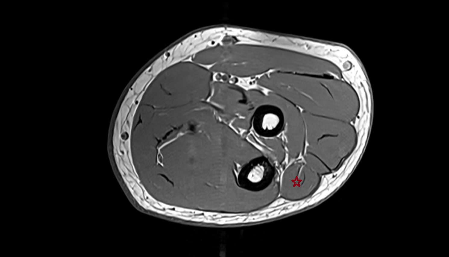 Extensor carpi ulnaris  muscle  axial cross sectional anatomy 3T MRI AI enhanced radiology image -img-00000-00000_00002
