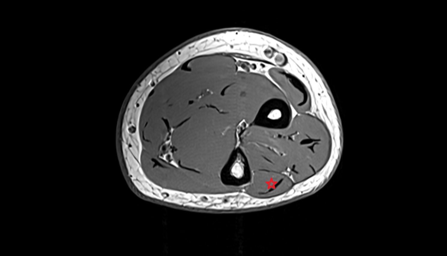 Extensor carpi ulnaris  muscle  axial cross sectional anatomy 3T MRI AI enhanced radiology image -img-00000-00000_00003