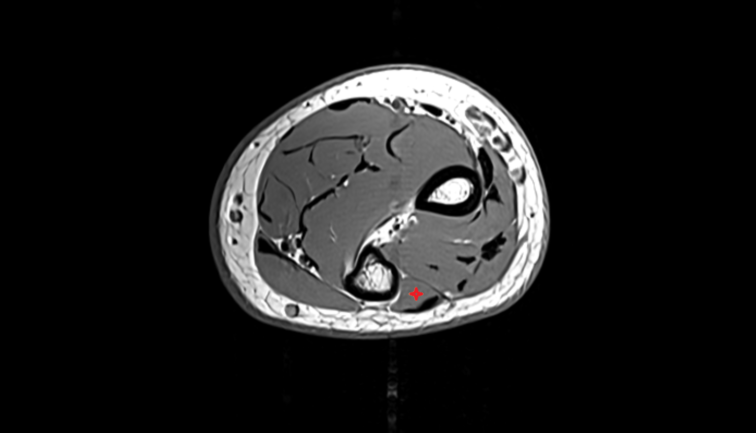 Extensor carpi ulnaris  muscle  axial cross sectional anatomy 3T MRI AI enhanced radiology image -img-00000-00000_00004