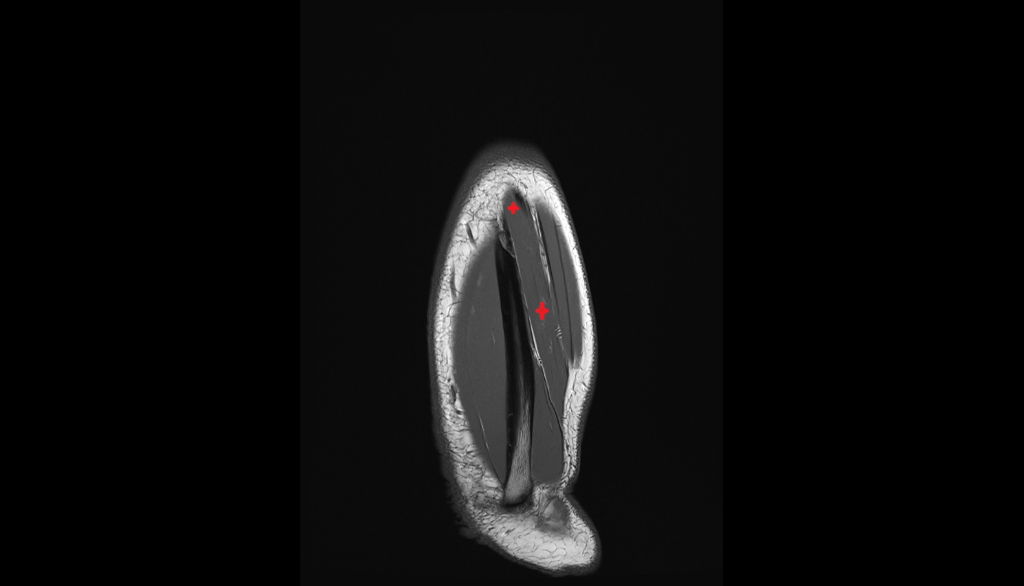 Extensor carpi ulnaris  muscle  coronal cross sectional anatomy 3T MRI AI enhanced radiology image -img-00000-00000_00005
