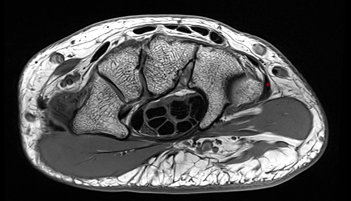 Extensor carpi ulnaris tendo  axial cross sectional anatomy 3T MRI AI enhanced radiology image-img-00000-00000