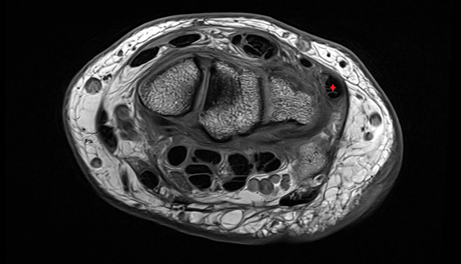 Extensor carpi ulnaris tendo  axial cross sectional anatomy 3T MRI AI enhanced radiology image-img-00000-00000_00001