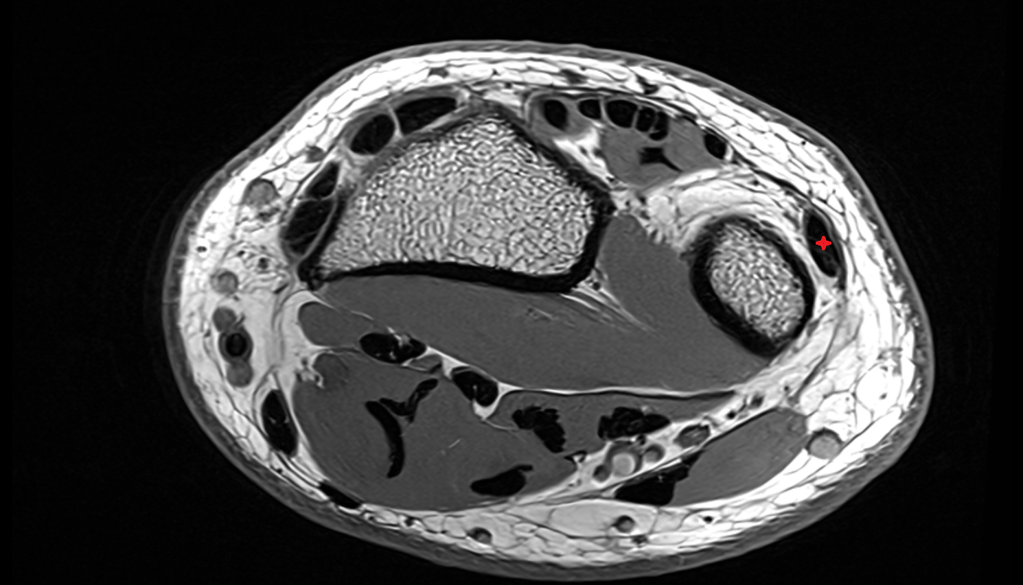 Extensor carpi ulnaris tendo  axial cross sectional anatomy 3T MRI AI enhanced radiology image-img-00000-00000_00002