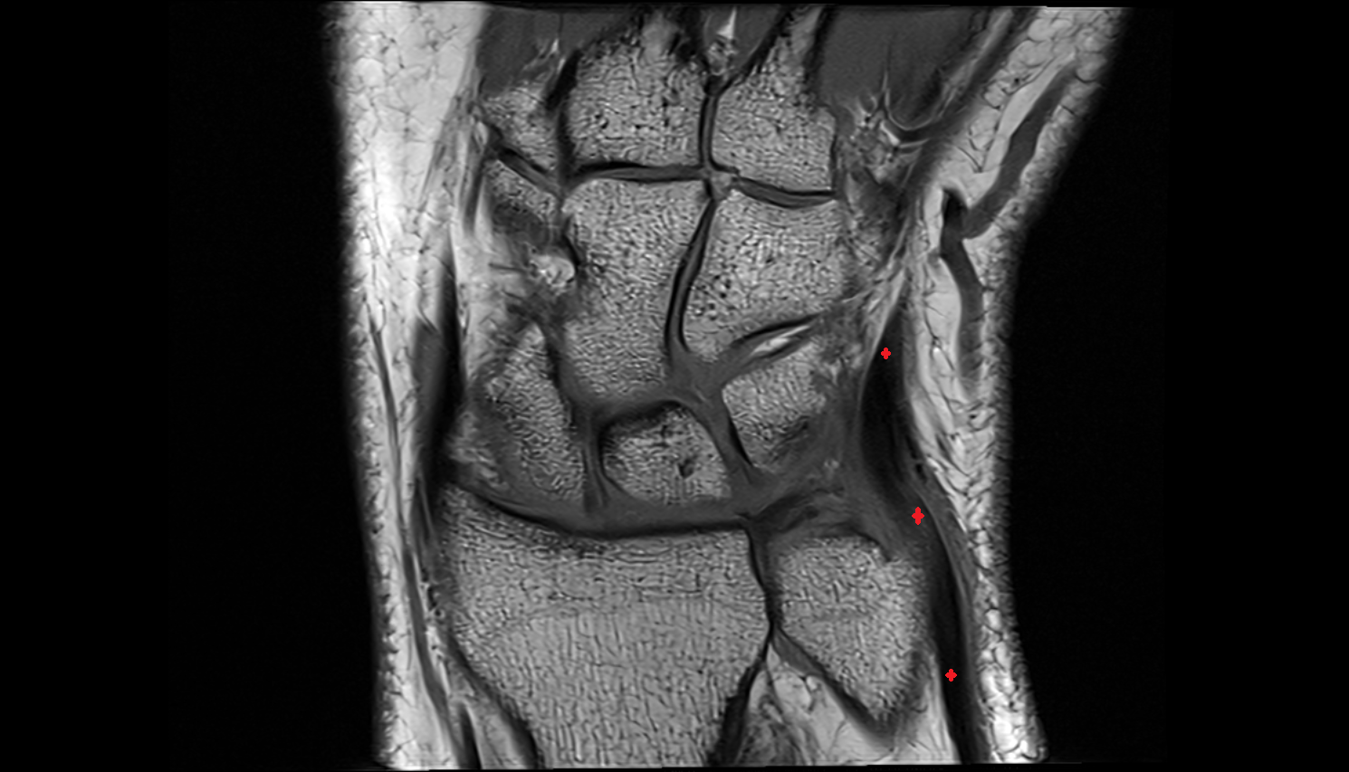 Extensor carpi ulnaris tendon coronal cross sectional anatomy 3T MRI AI enhanced radiology image-img-00000-00000