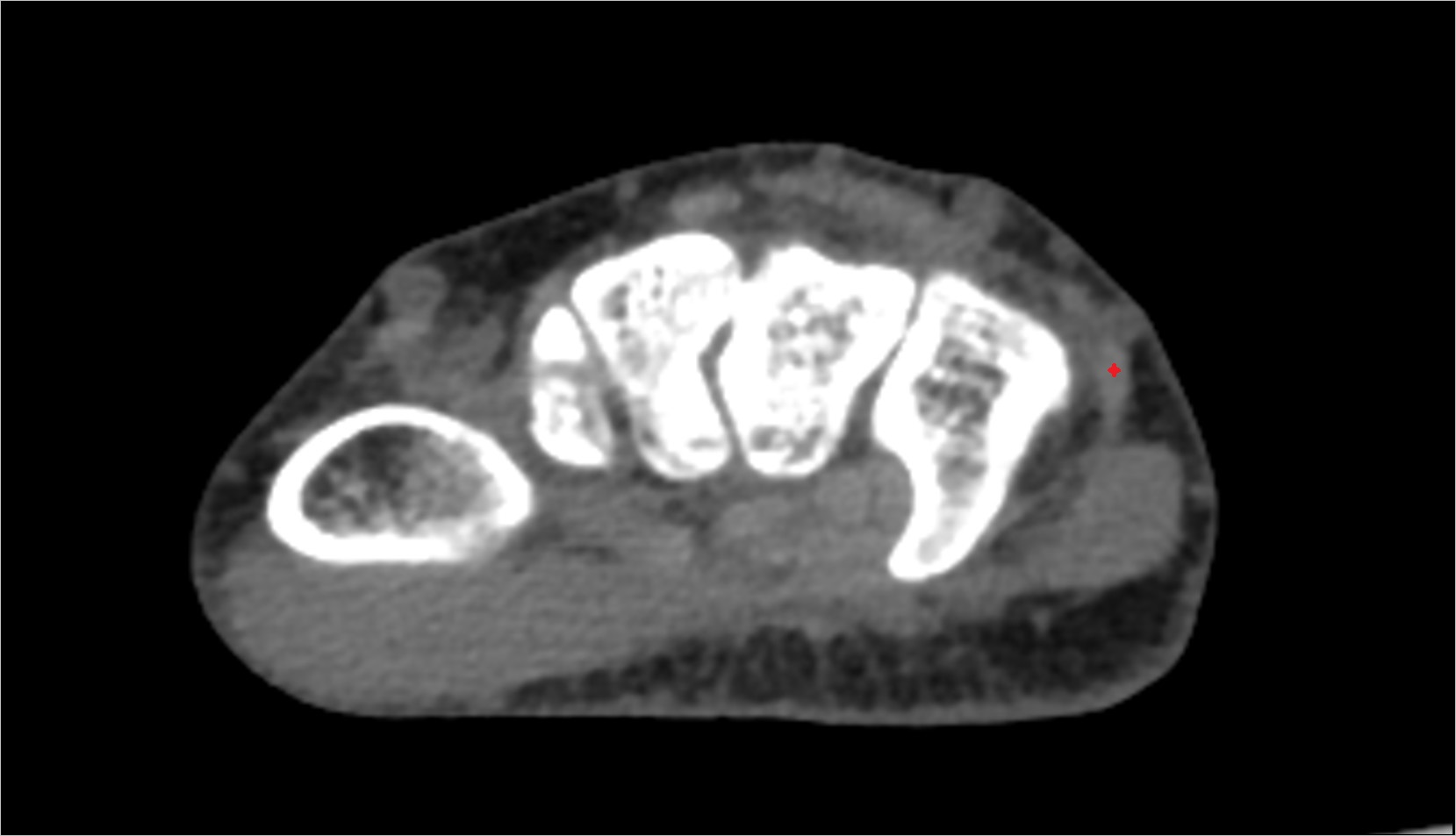 Extensor carpi ulnaris tendon ct axial