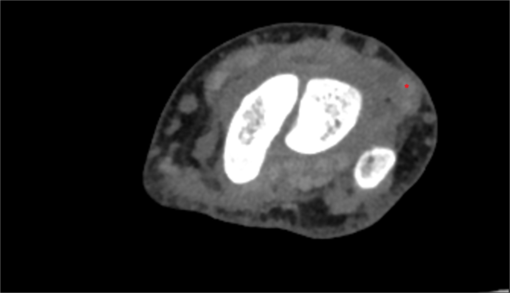 Extensor carpi ulnaris tendon ct axial 1
