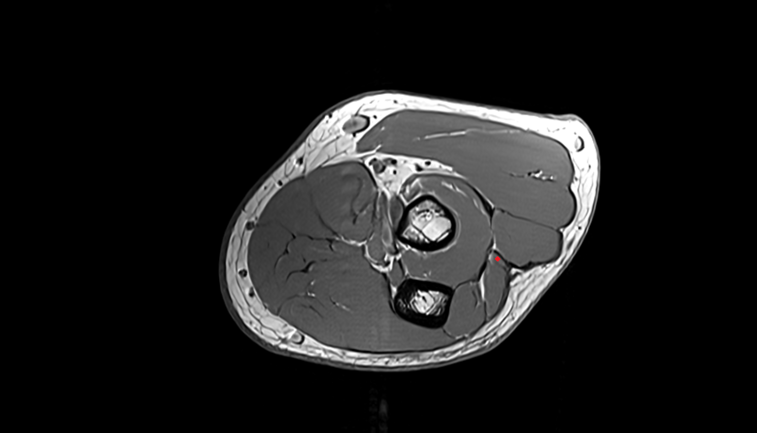 Extensor digiti minimi  muscle  axial cross sectional anatomy 3T MRI AI enhanced radiology image -img-00000-00000