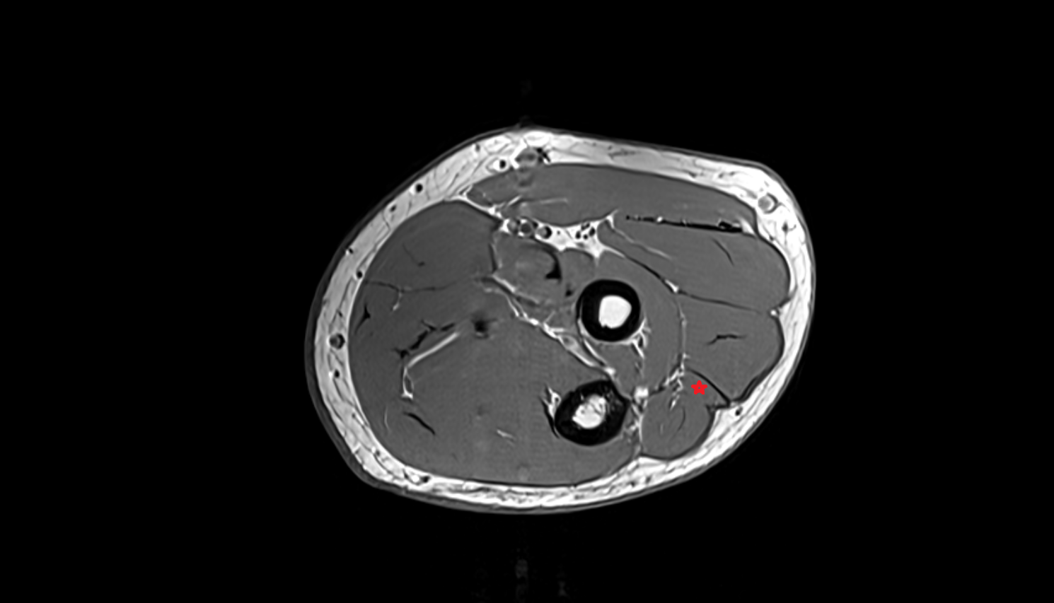 Extensor digiti minimi  muscle  axial cross sectional anatomy 3T MRI AI enhanced radiology image -img-00000-00000_00001