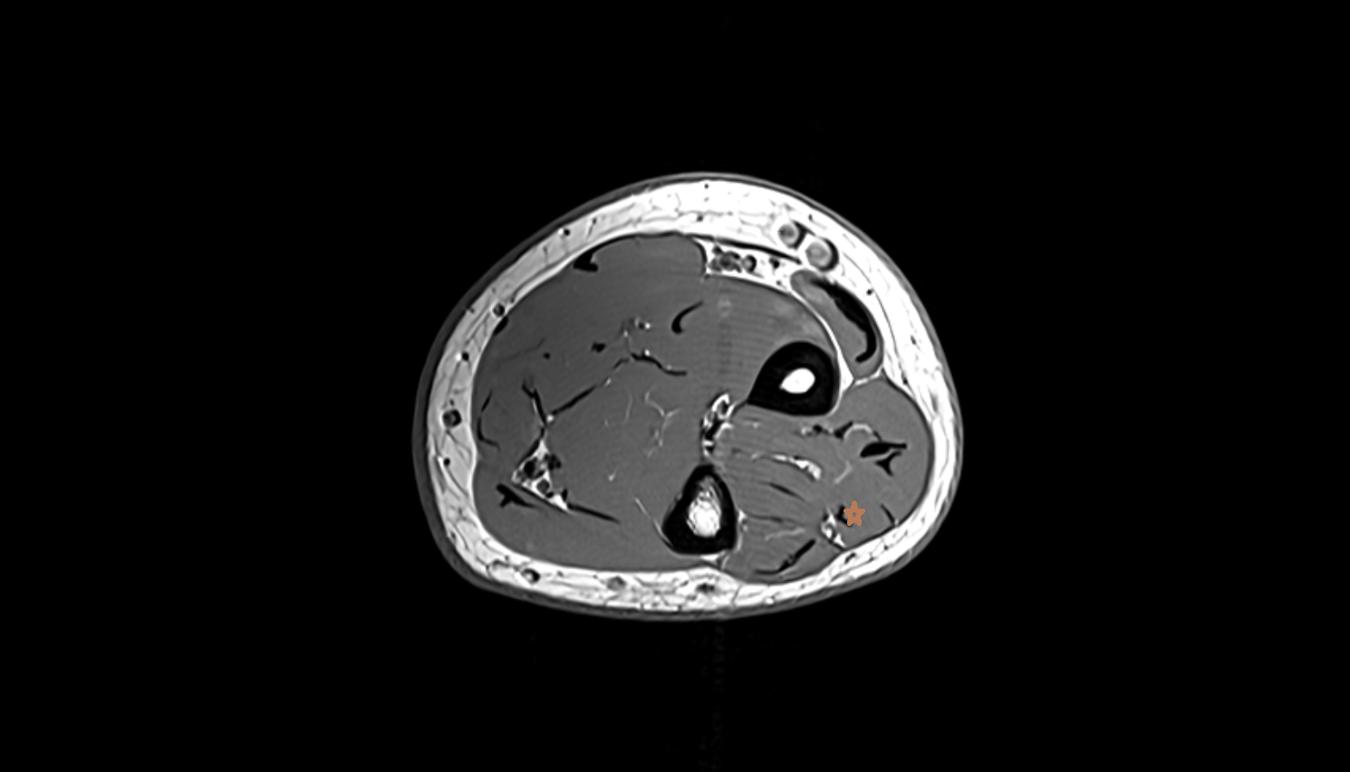 Extensor digiti minimi  muscle  axial cross sectional anatomy 3T MRI AI enhanced radiology image -img-00000-00000_00003
