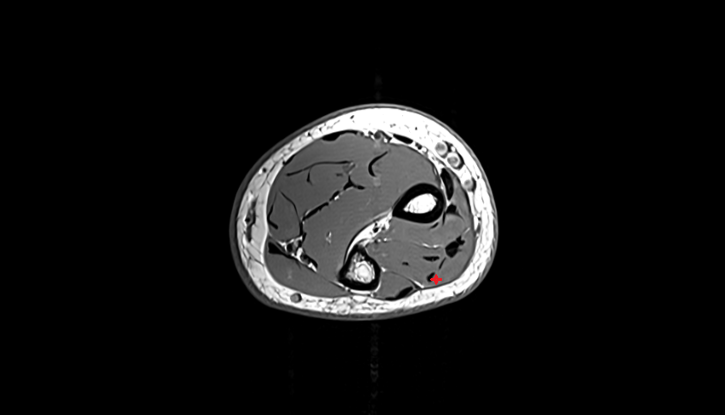 Extensor digiti minimi  muscle  axial cross sectional anatomy 3T MRI AI enhanced radiology image -img-00000-00000_00004