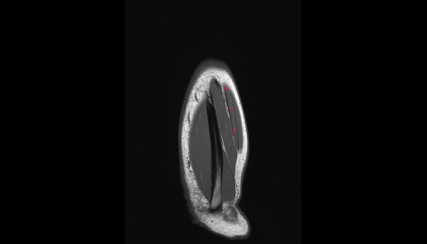 Extensor digiti minimi  muscle  coronal cross sectional anatomy 3T MRI AI enhanced radiology image -img-00000-00000_00005