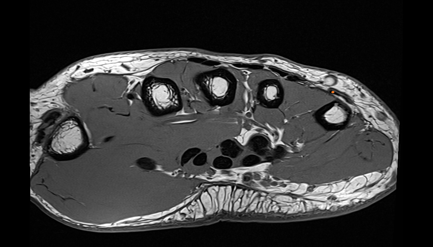 Extensor digiti minimi tendon  axial cross sectional anatomy 3T MRI AI enhanced radiology image-img-00000-00000