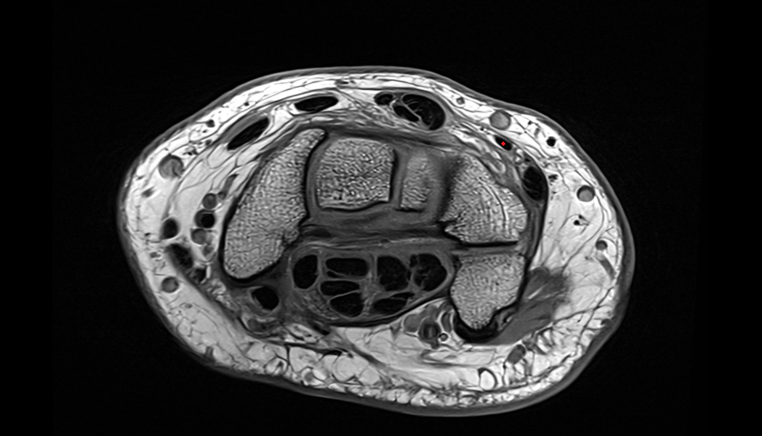 Extensor digiti minimi tendon  axial cross sectional anatomy 3T MRI AI enhanced radiology image-img-00000-00000_00001