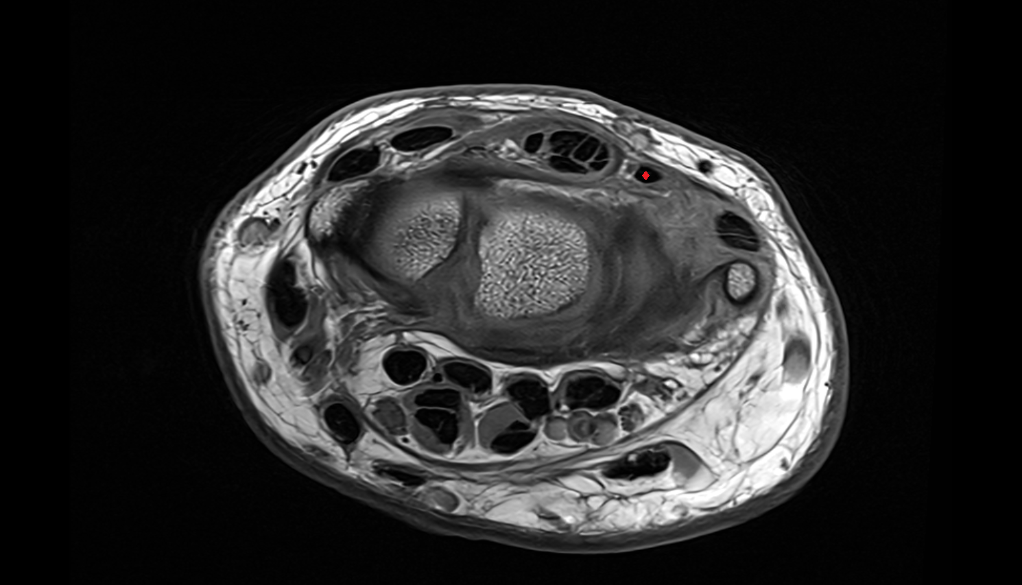 Extensor digiti minimi tendon  axial cross sectional anatomy 3T MRI AI enhanced radiology image-img-00000-00000_00002