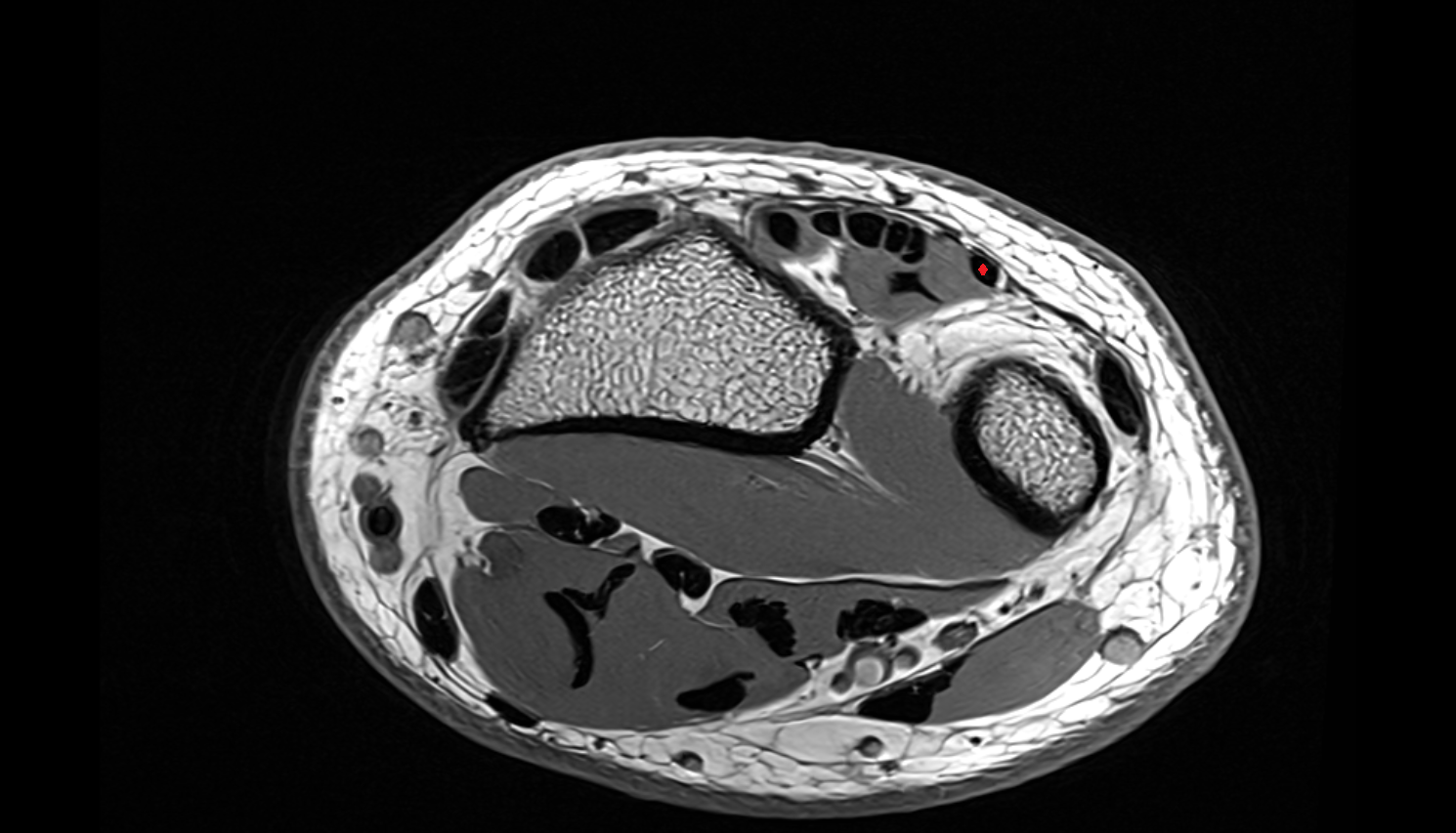 Extensor digiti minimi tendon  axial cross sectional anatomy 3T MRI AI enhanced radiology image-img-00000-00000_00003