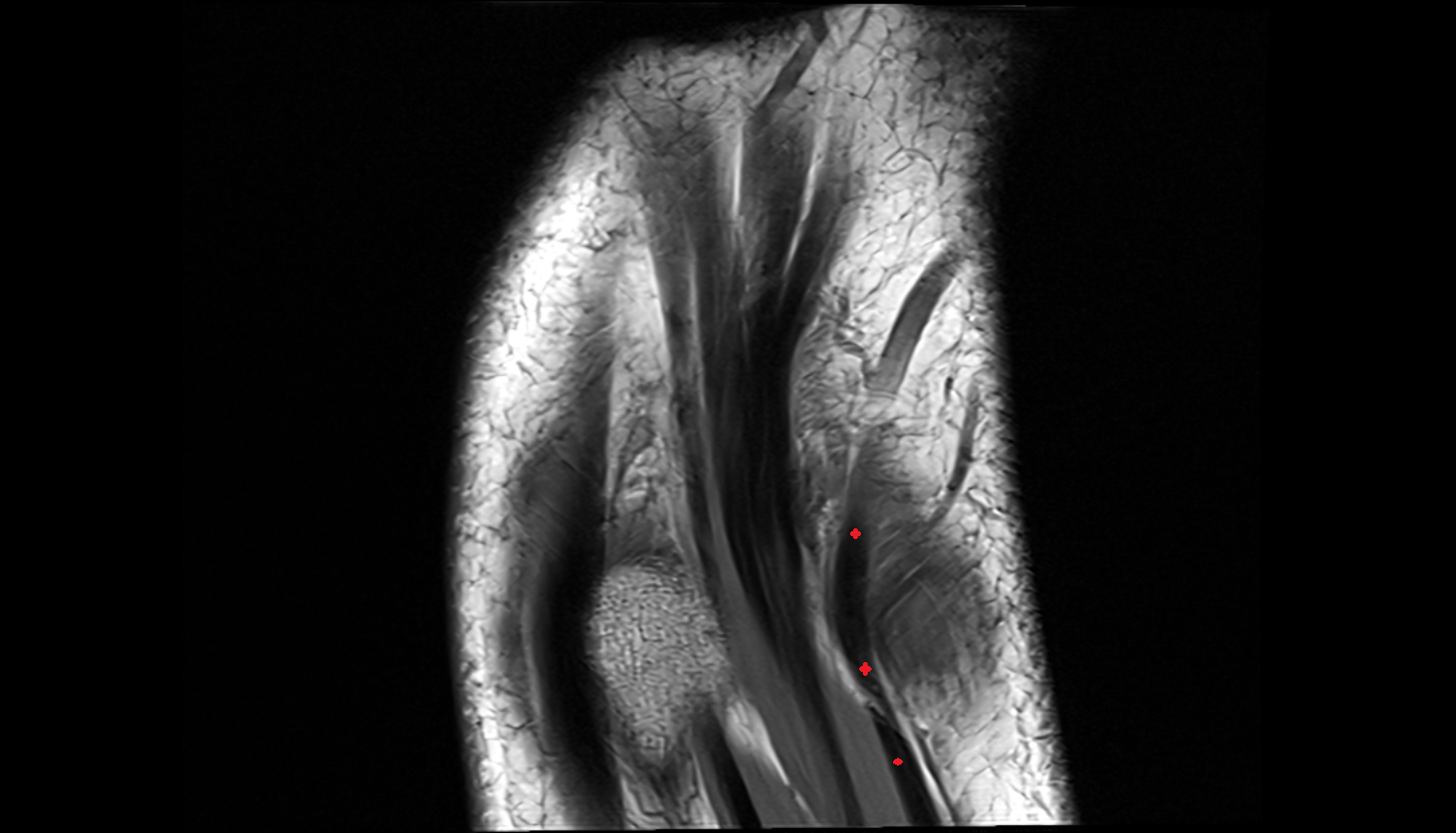 Extensor digiti minimi tendon coronal cross sectional anatomy 3T MRI AI enhanced radiology image-img-00000-00000