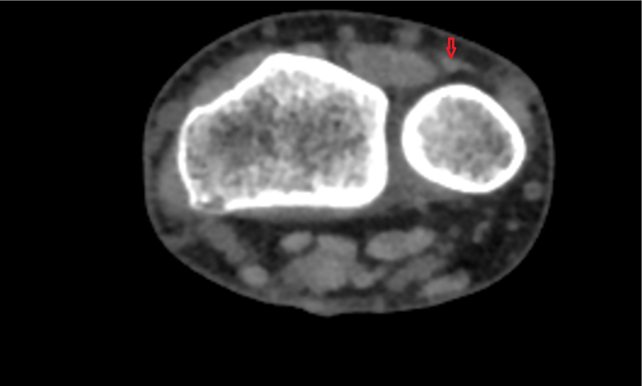 Extensor digiti minimi tendon ct axial