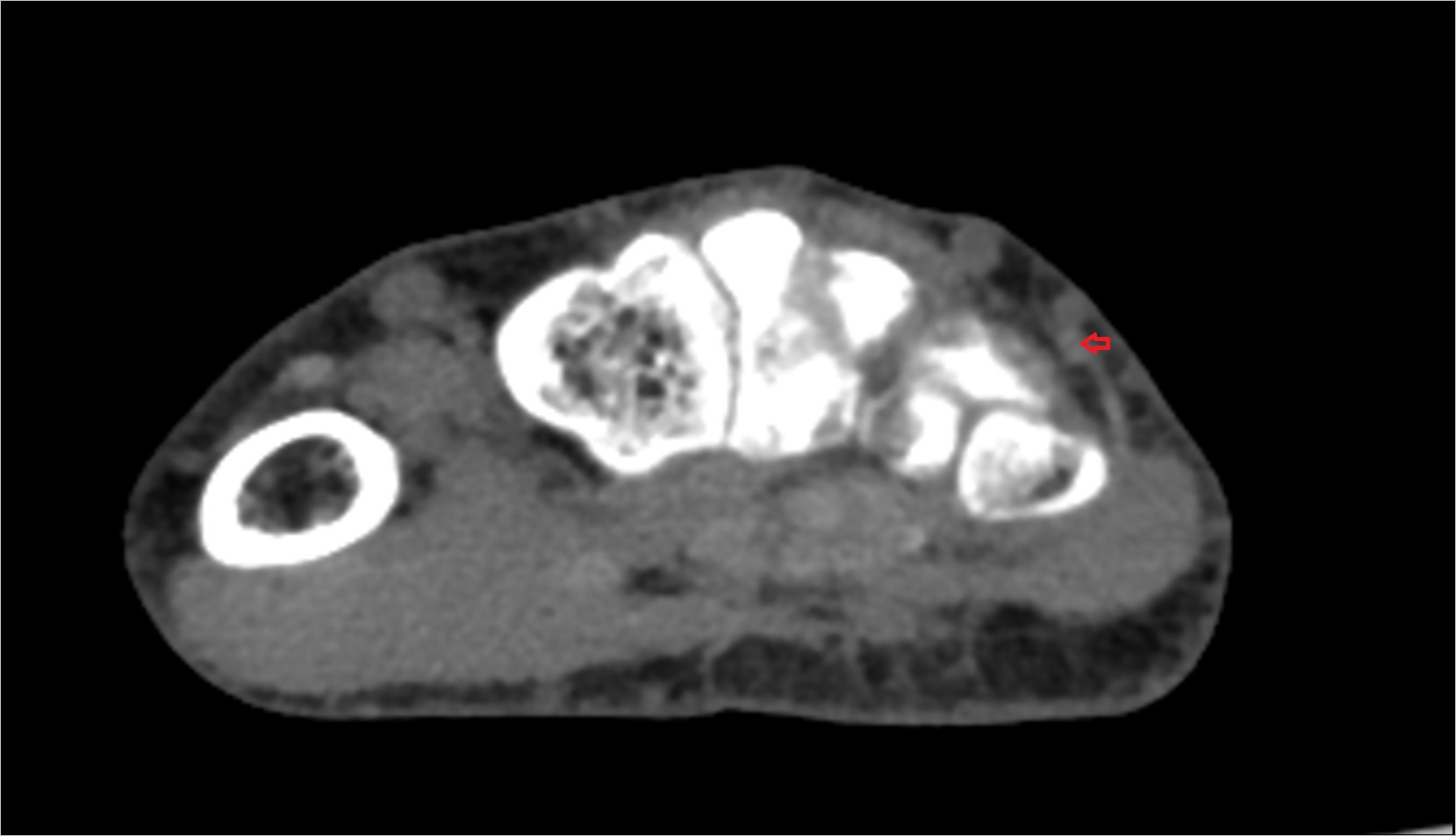 Extensor digiti minimi tendon ct axial 1