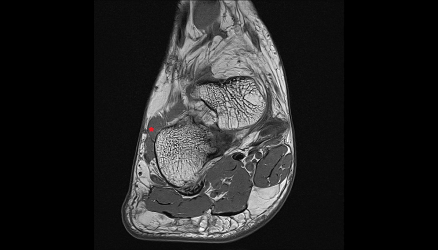 Extensor digitorum brevis muscle axial cross sectional anatomy 3T MRI AI enhanced radiology image-img-00000-00000
