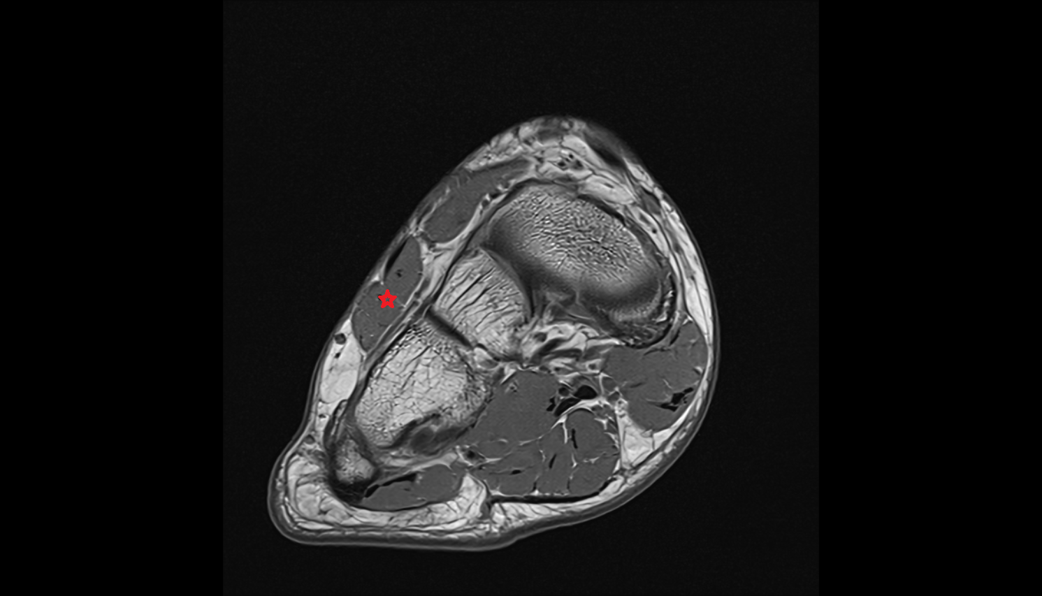Extensor digitorum brevis muscle axial cross sectional anatomy 3T MRI AI enhanced radiology image-img-00000-00000_00001