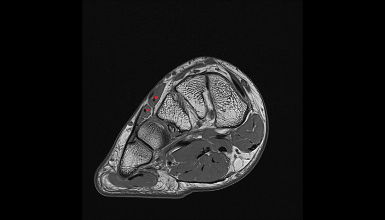 Extensor digitorum brevis muscle axial cross sectional anatomy 3T MRI AI enhanced radiology image-img-00000-00000_00002