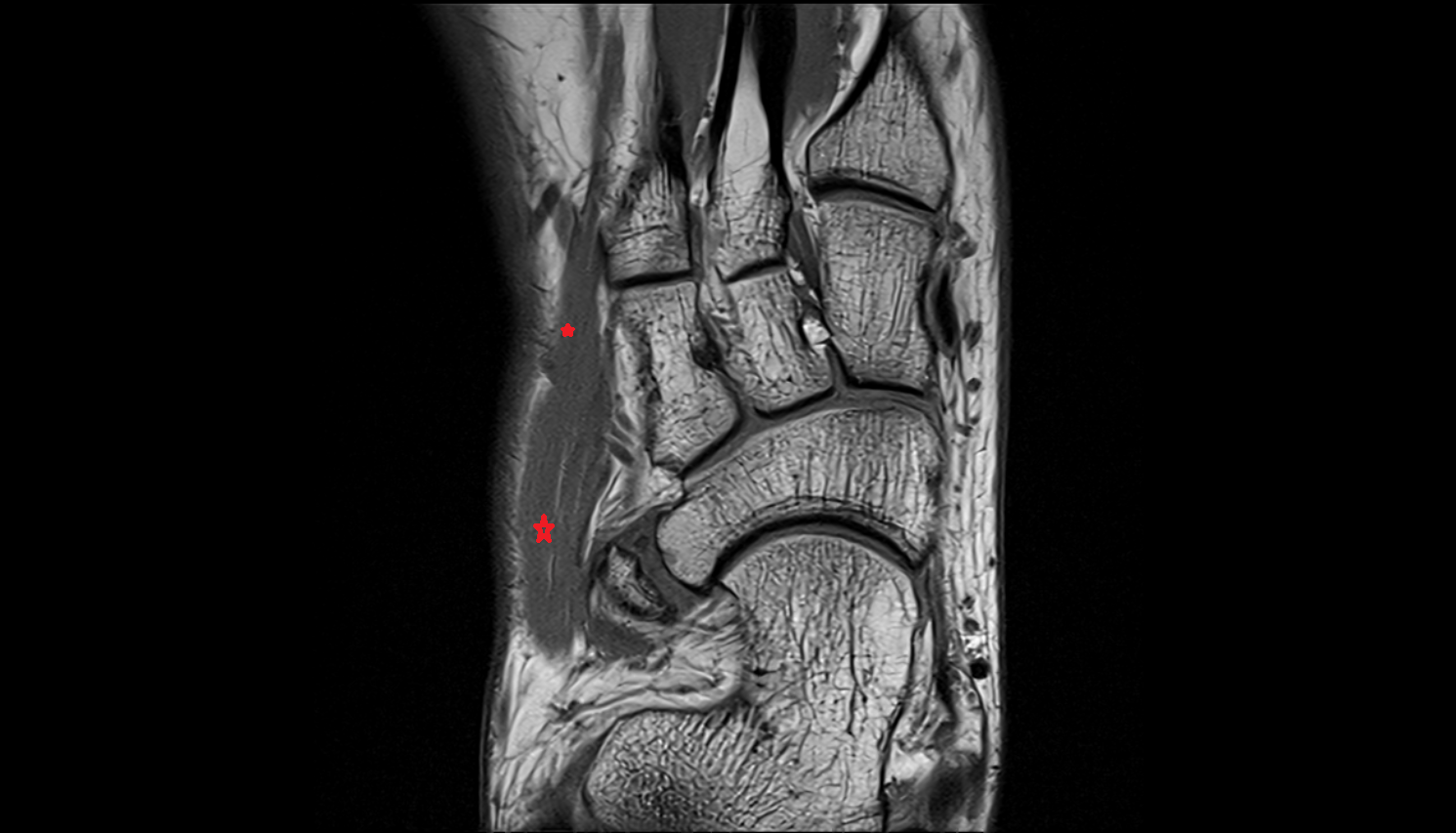 Extensor digitorum brevis muscle  coronal cross sectional anatomy 3T MRI AI enhanced radiology image-img-00000-00000