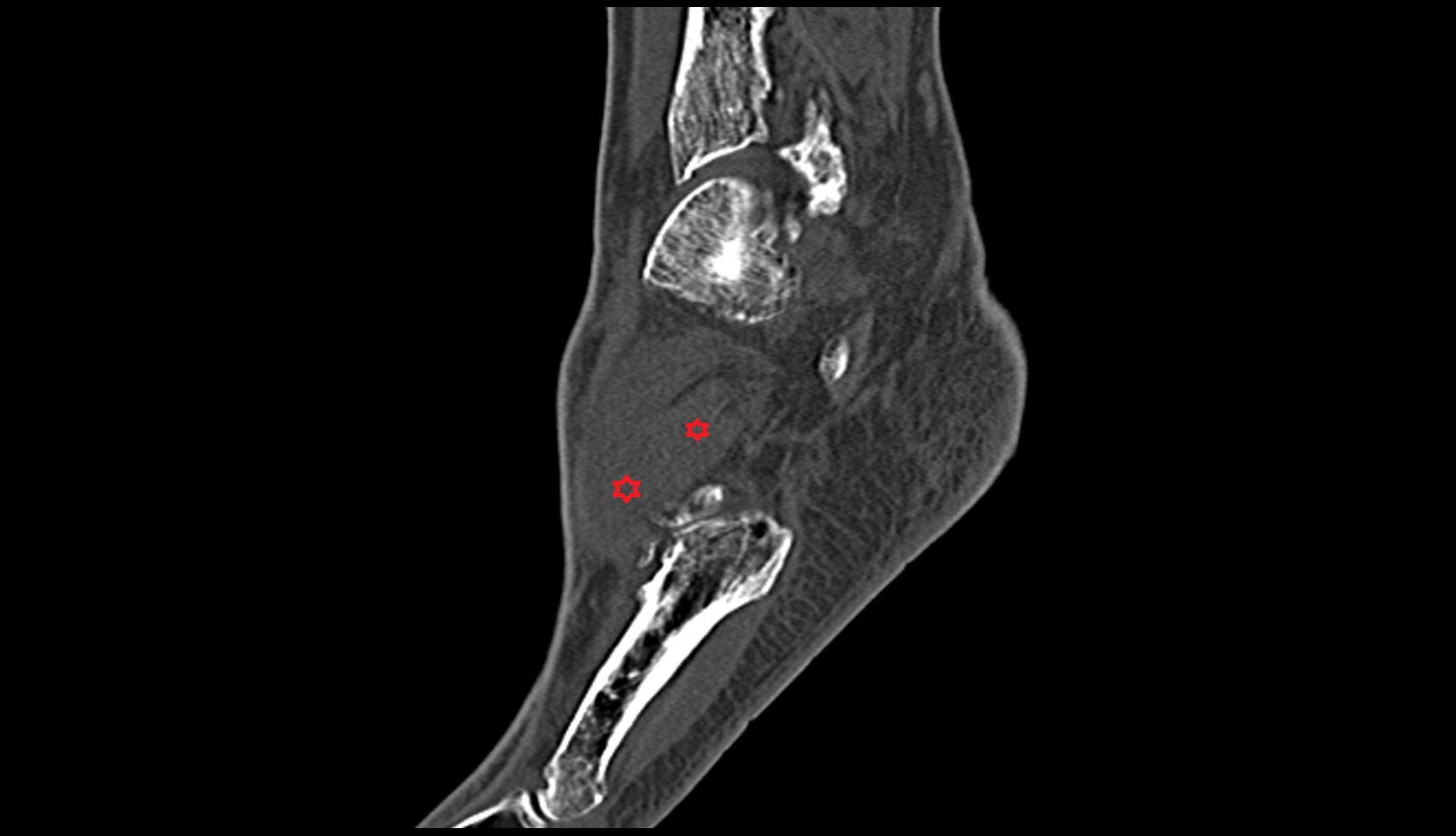 Extensor digitorum brevis muscle ct sagittal image