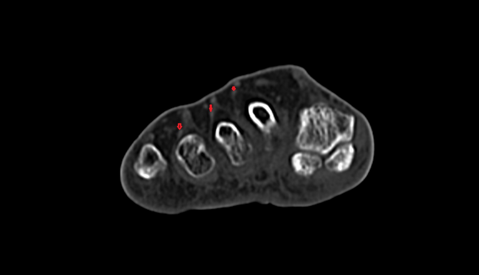 Extensor digitorum brevis tendons ct