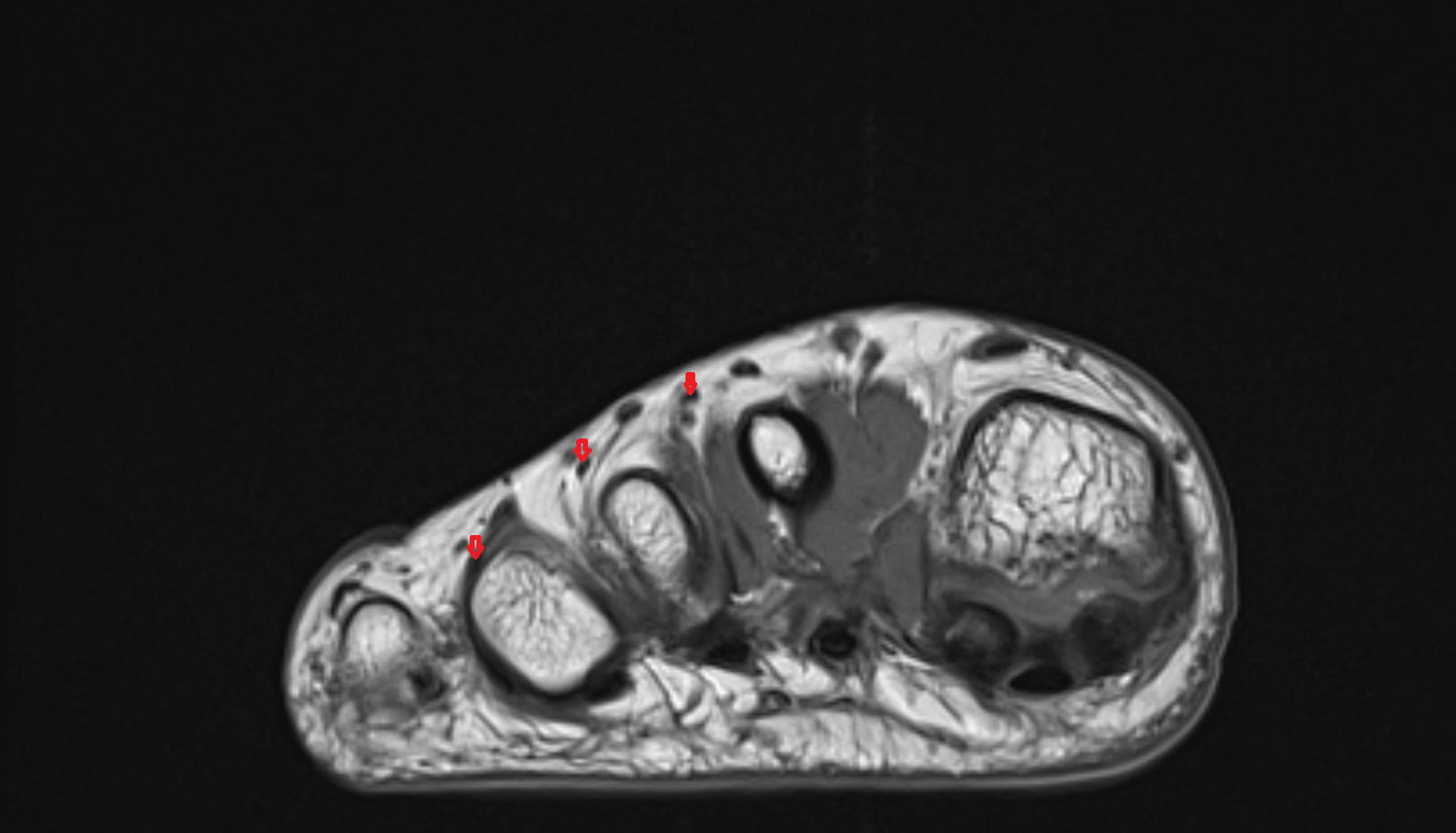 Extensor digitorum brevis tendons  of the Foot  axial cross sectional anatomy 3T MRI AI enhanced radiology image-img-00000-00000