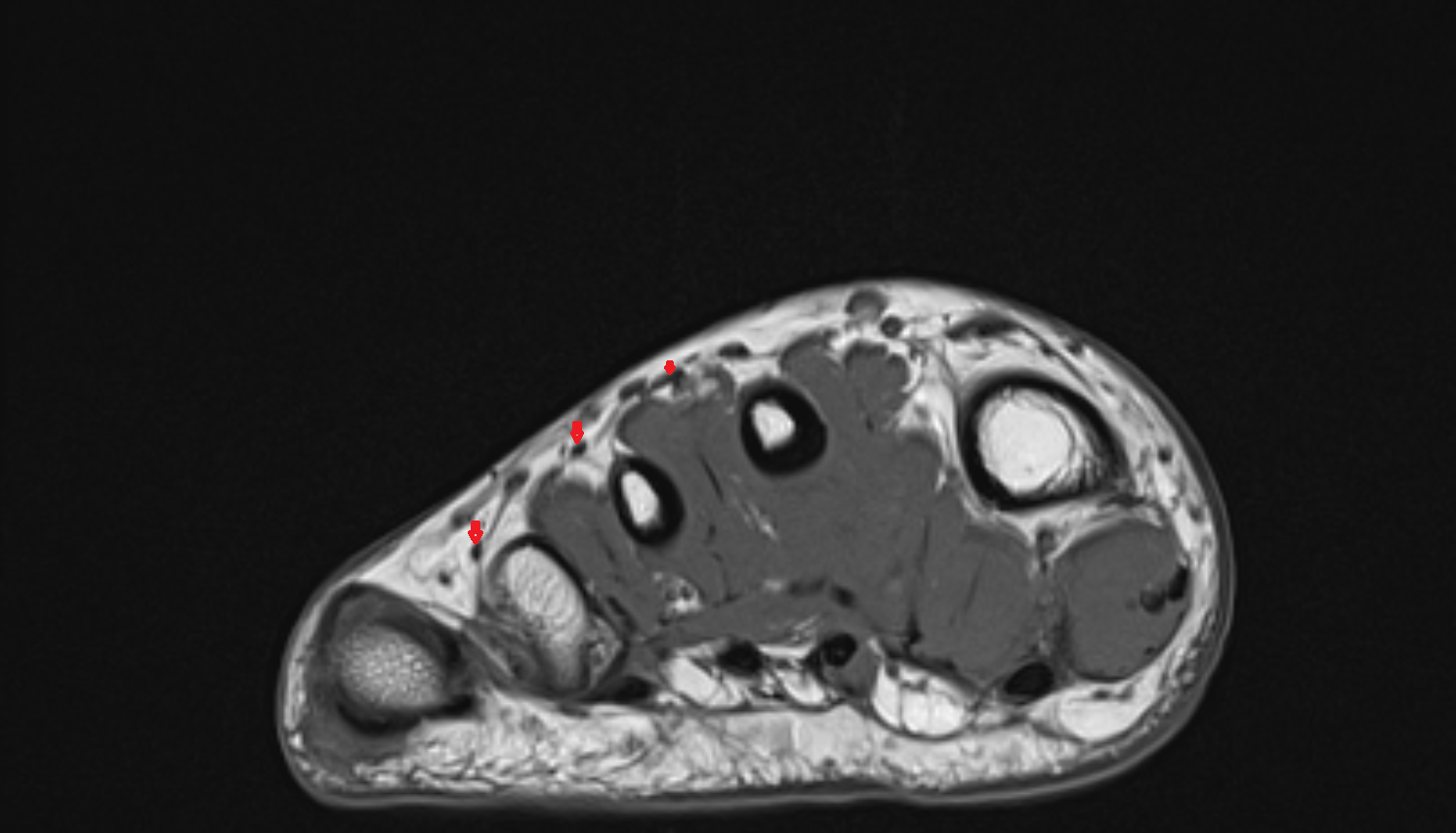 Extensor digitorum brevis tendons  of the Foot  axial cross sectional anatomy 3T MRI AI enhanced radiology image-img-00000-00000_00001