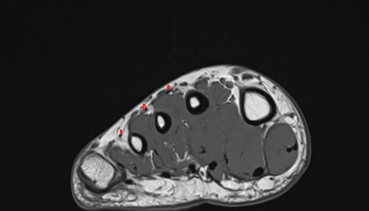 Extensor digitorum brevis tendons  of the Foot  axial cross sectional anatomy 3T MRI AI enhanced radiology image-img-00000-00000_00002