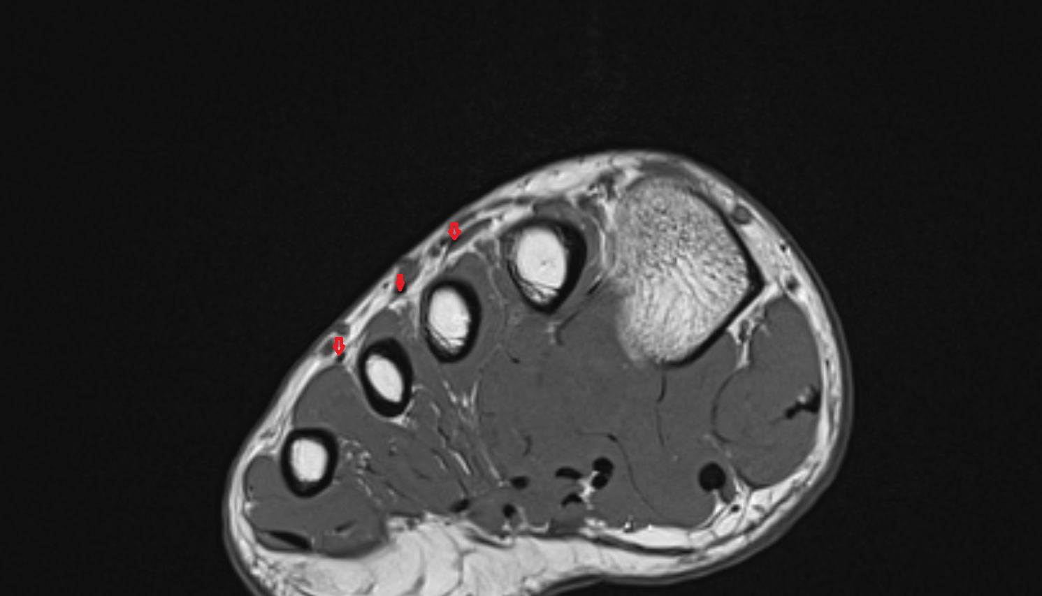 Extensor digitorum brevis tendons  of the Foot  axial cross sectional anatomy 3T MRI AI enhanced radiology image-img-00000-00000_00003