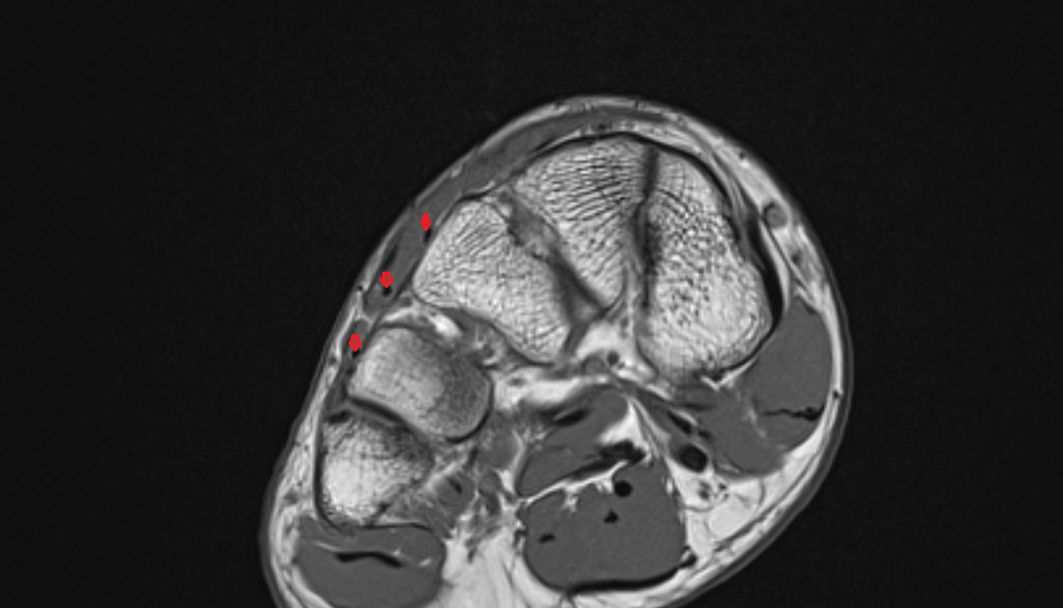 Extensor digitorum brevis tendons  of the Foot  axial cross sectional anatomy 3T MRI AI enhanced radiology image-img-00000-00000_00004