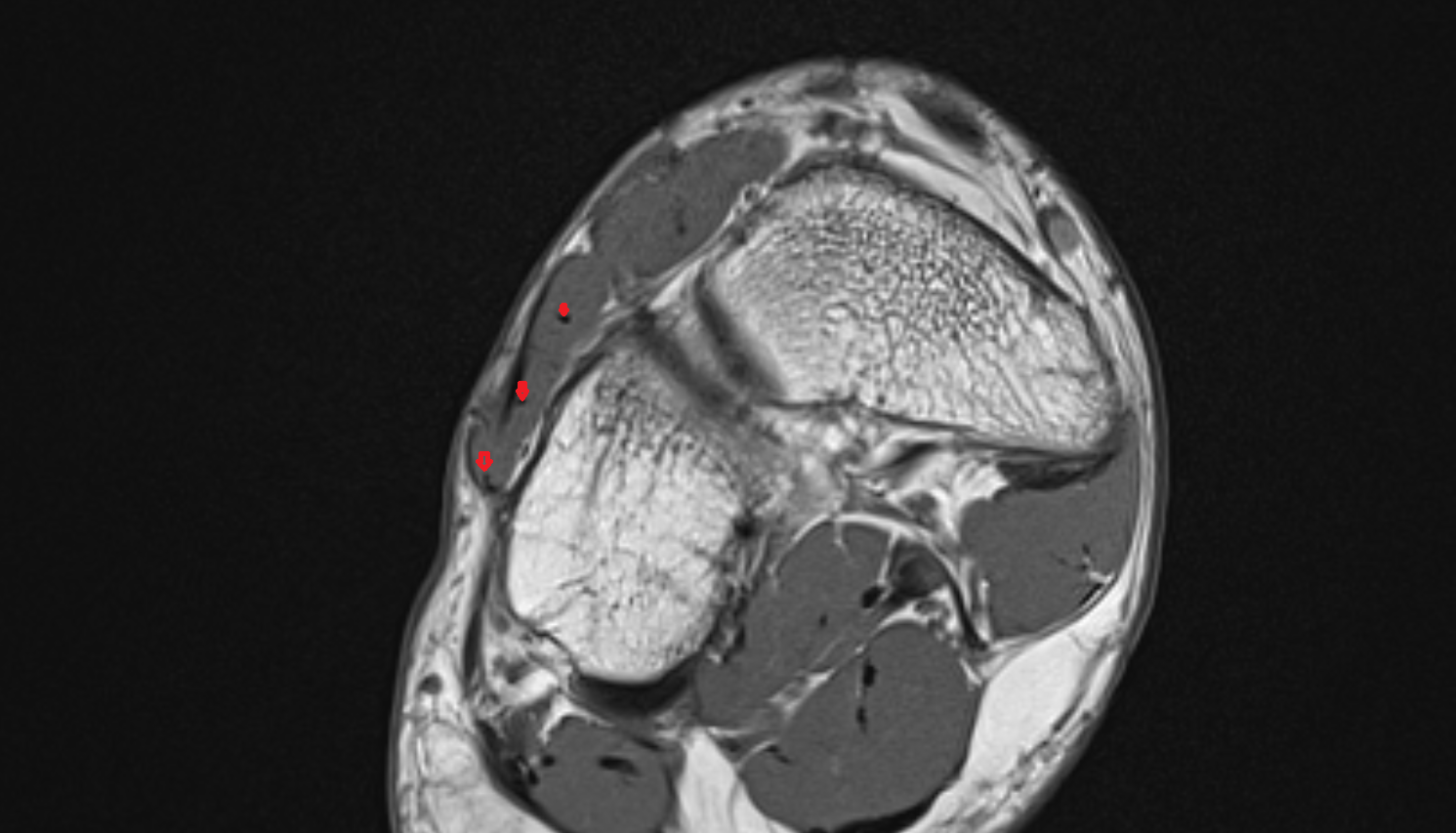 Extensor digitorum brevis tendons  of the Foot  axial cross sectional anatomy 3T MRI AI enhanced radiology image-img-00000-00000_00005