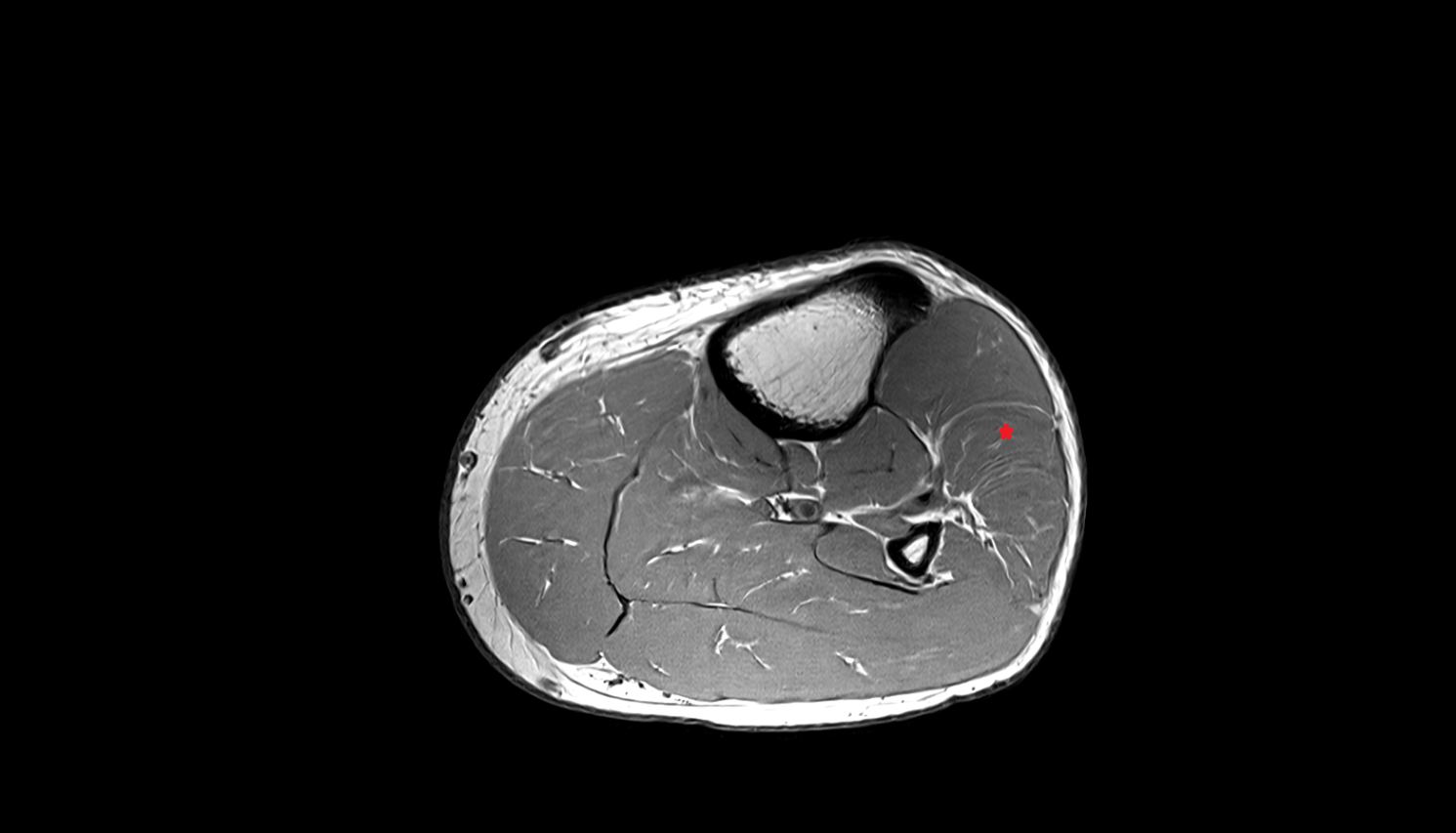 Extensor digitorum longus muscle   MRI sag  cross sectional anatomy 3T MRI AI enhanced radiology image-img-00000-00000