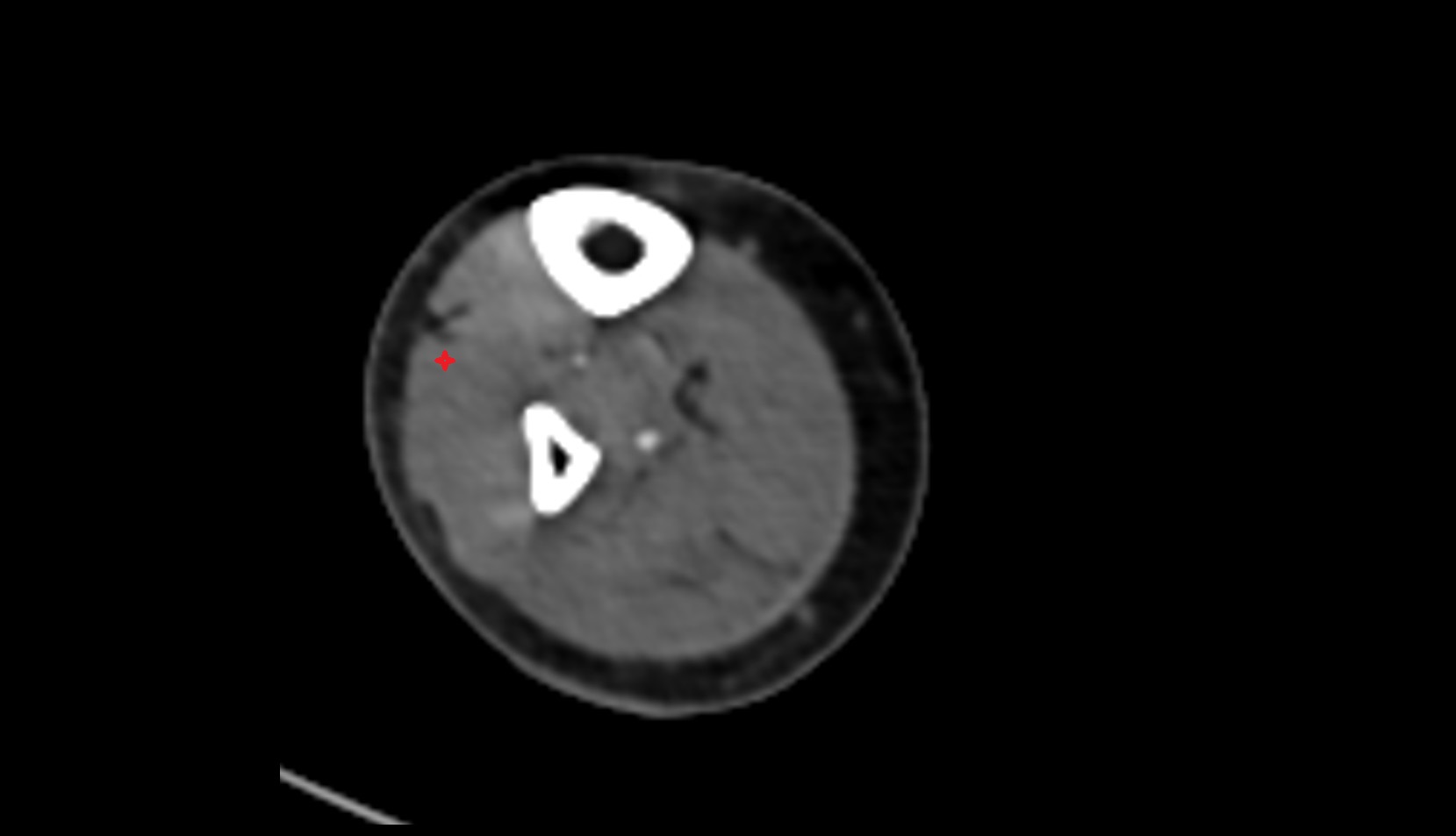 Extensor digitorum longus muscle axial ct image