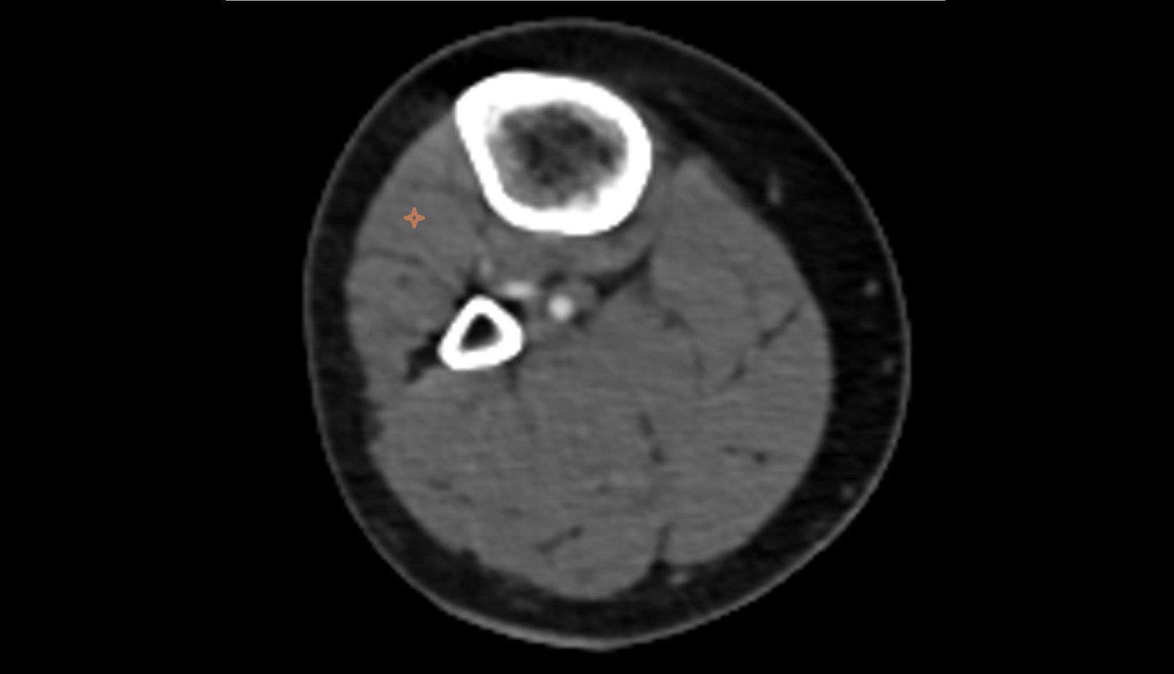 Extensor digitorum longus muscle axial ct image 2